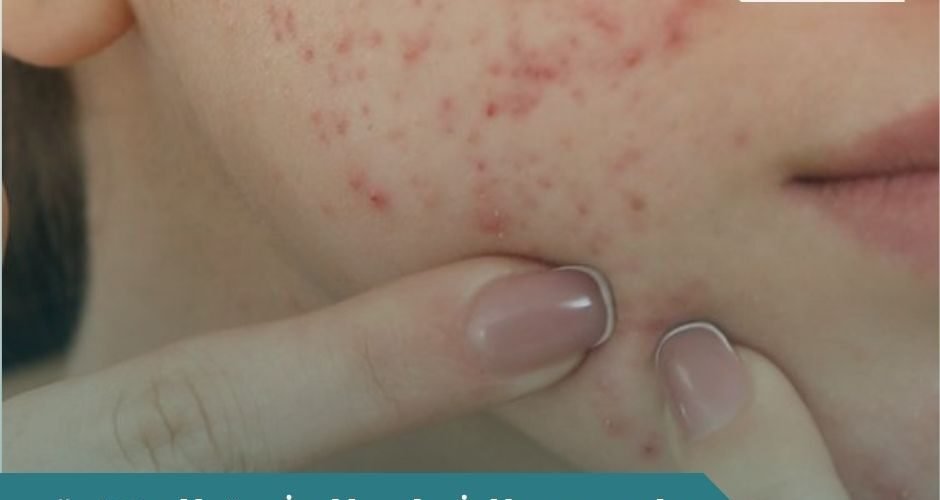 علاج حب الشباب للبشرة الدهنية​