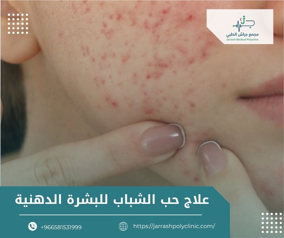 علاج حب الشباب للبشرة الدهنية​