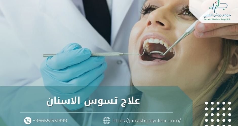 علاج تسوس الاسنان