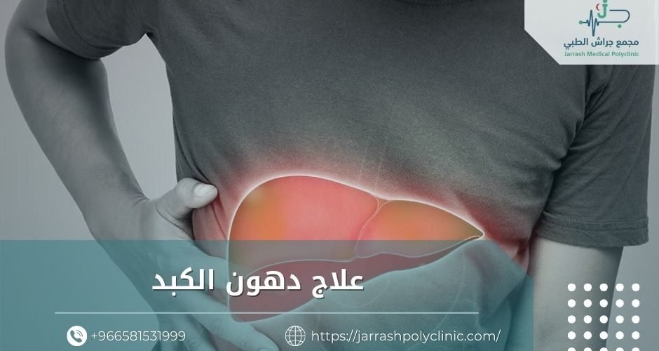 علاج دهون الكبد