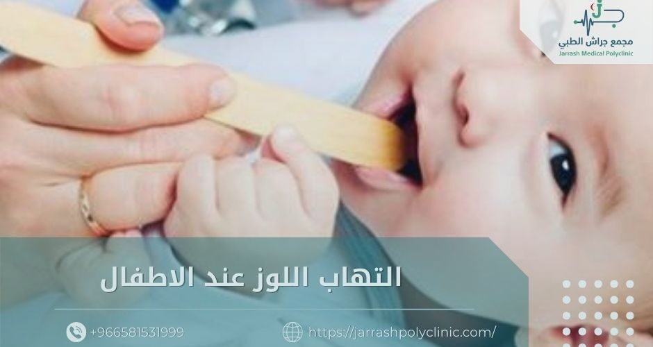 التهاب اللوز عند الاطفال​