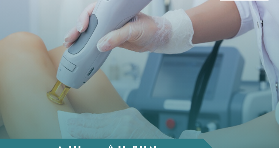 ازالة الشعر بالليزر