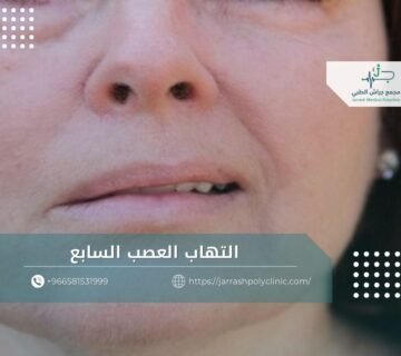 التهاب العصب السابع