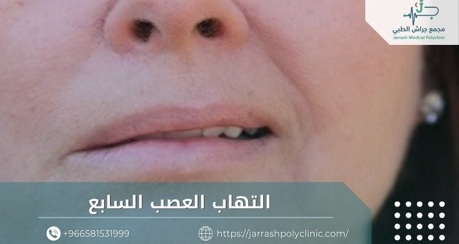 التهاب العصب السابع