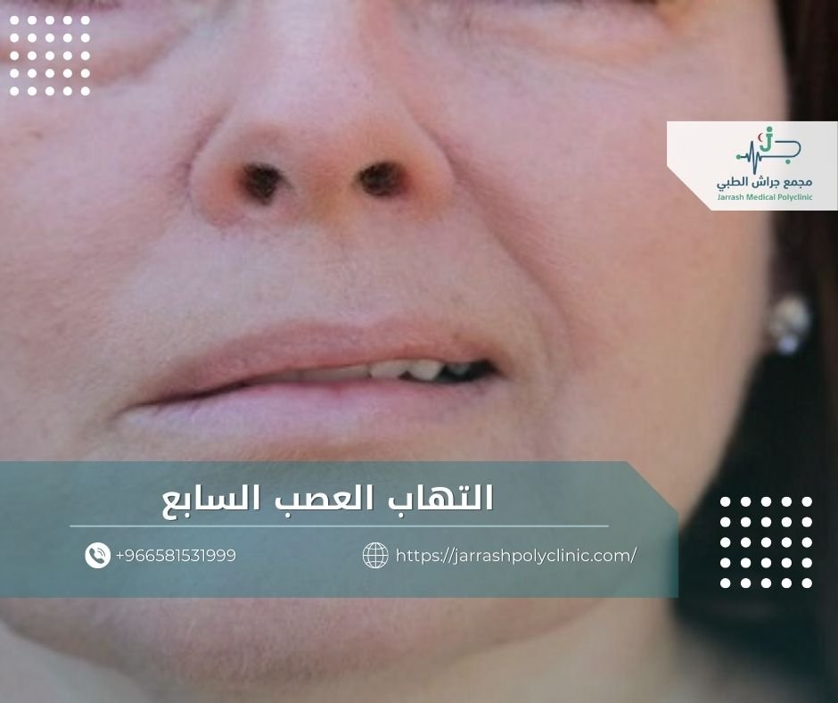 التهاب العصب السابع