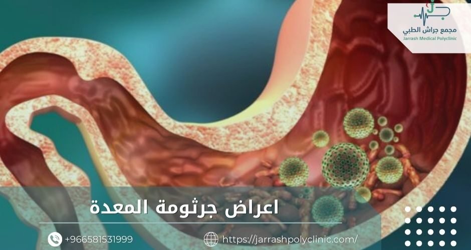 اعراض جرثومة المعدة