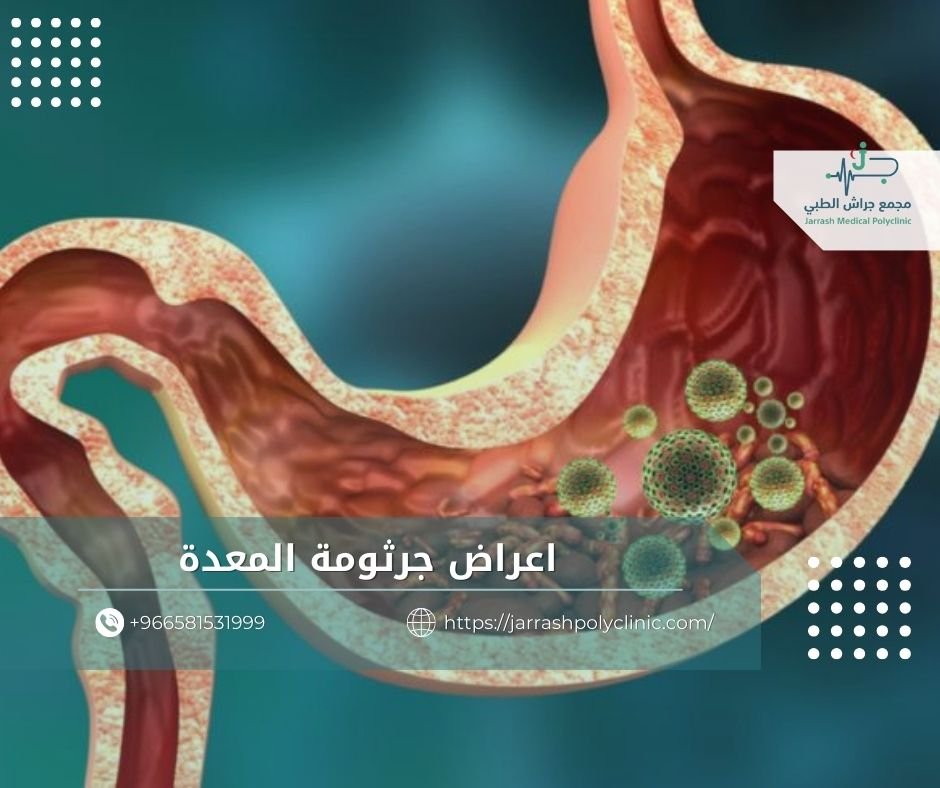 اعراض جرثومة المعدة