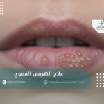 علاج الهربس الفموي