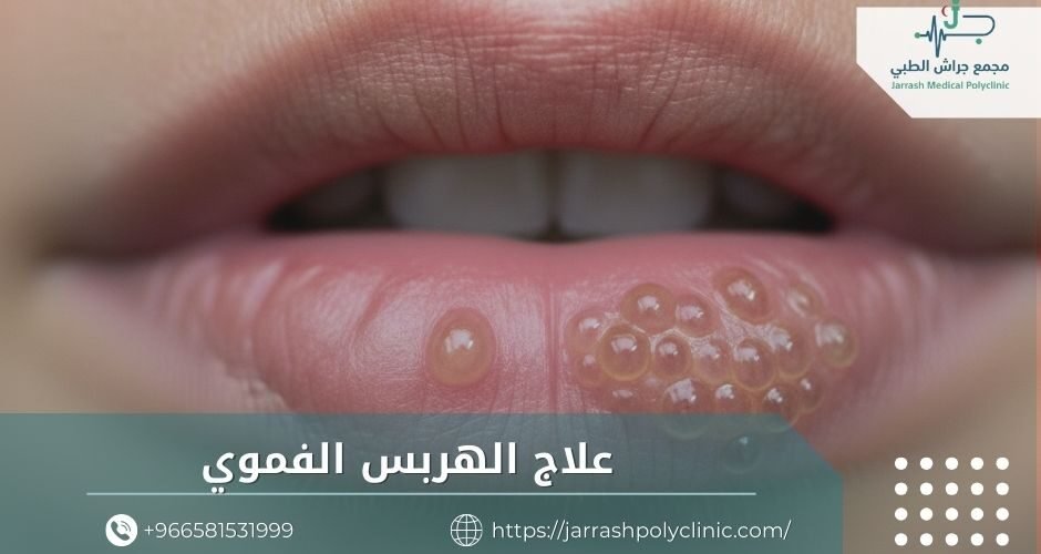 علاج الهربس الفموي