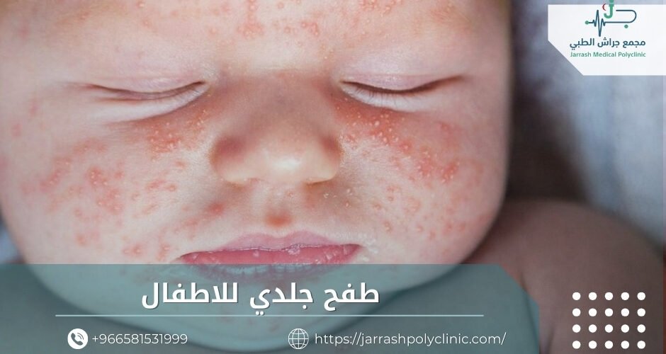 طفح جلدي للاطفال