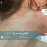 انواع حساسية الجلد