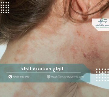انواع حساسية الجلد