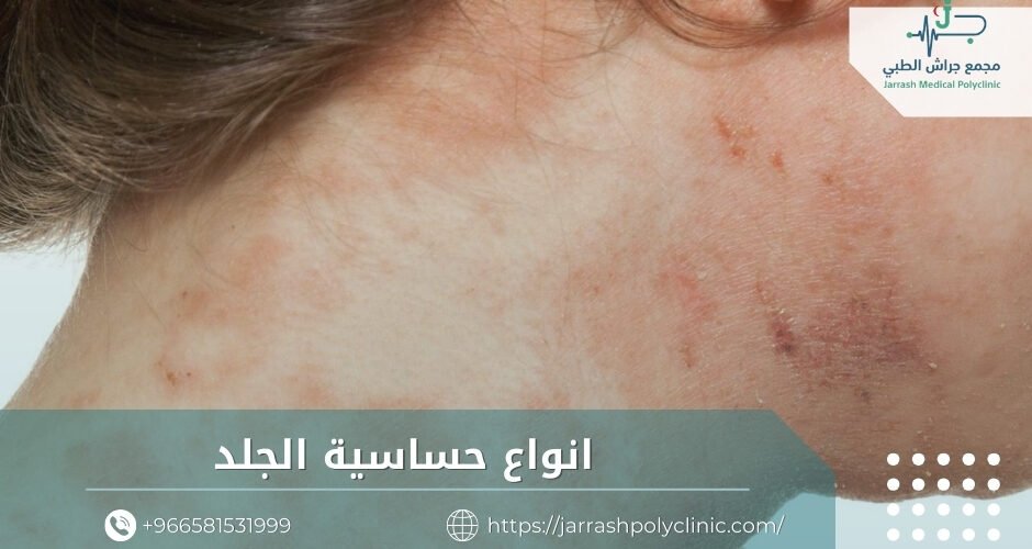 انواع حساسية الجلد