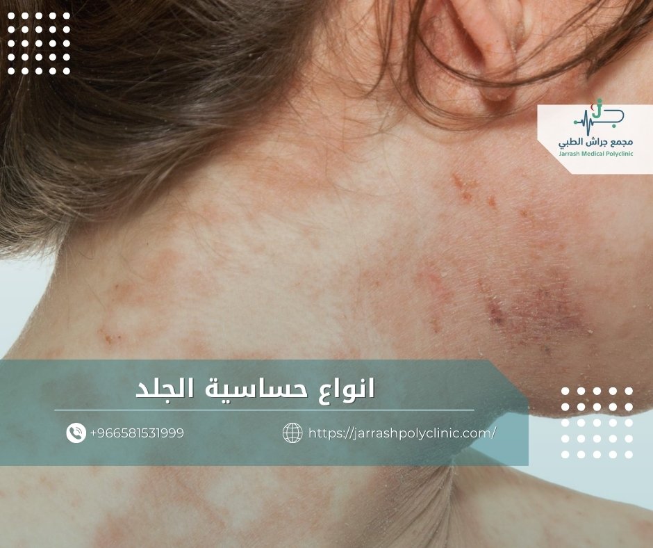 انواع حساسية الجلد