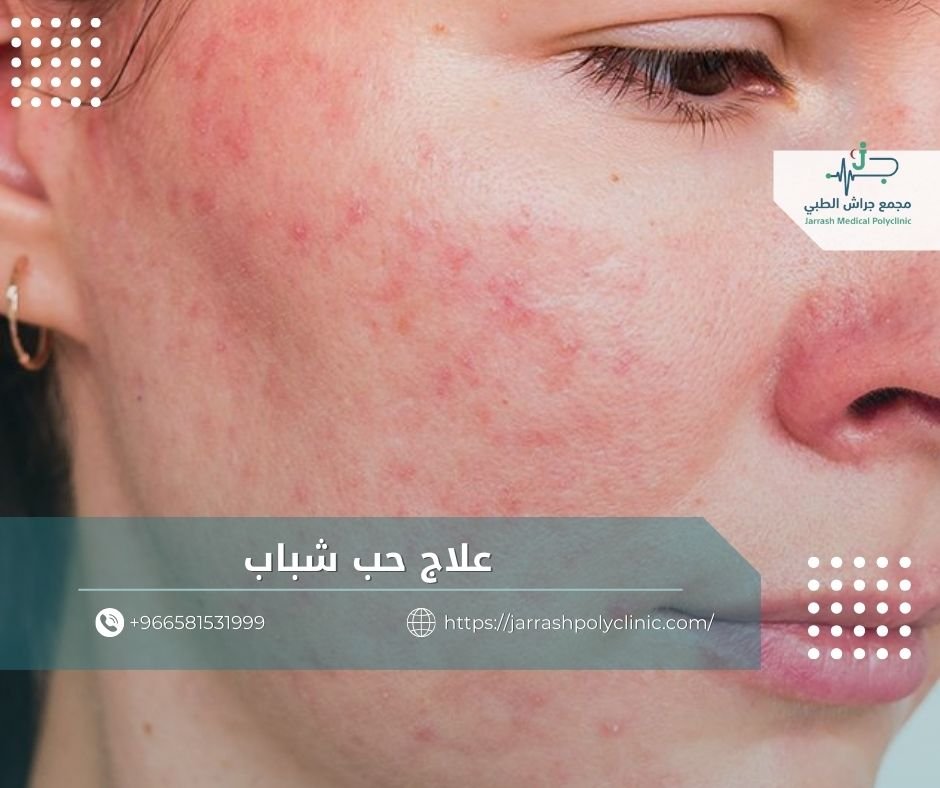علاج حب شباب