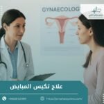 علاج تكيس المبايض