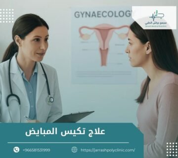 علاج تكيس المبايض