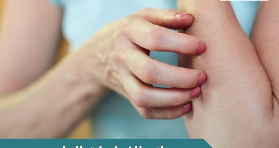 علاج الفطريات الجلديه