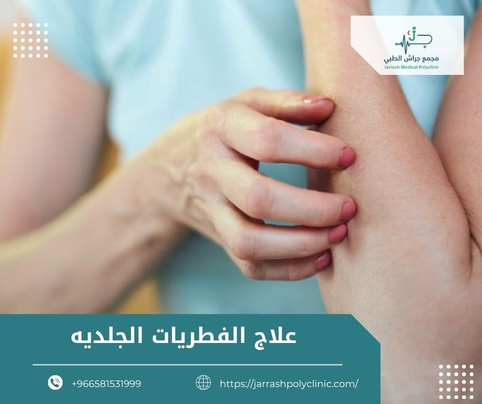 علاج الفطريات الجلديه