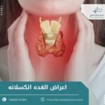 اعراض الغده الكسلانه