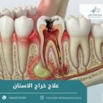 علاج خراج الاسنان