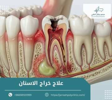 علاج خراج الاسنان