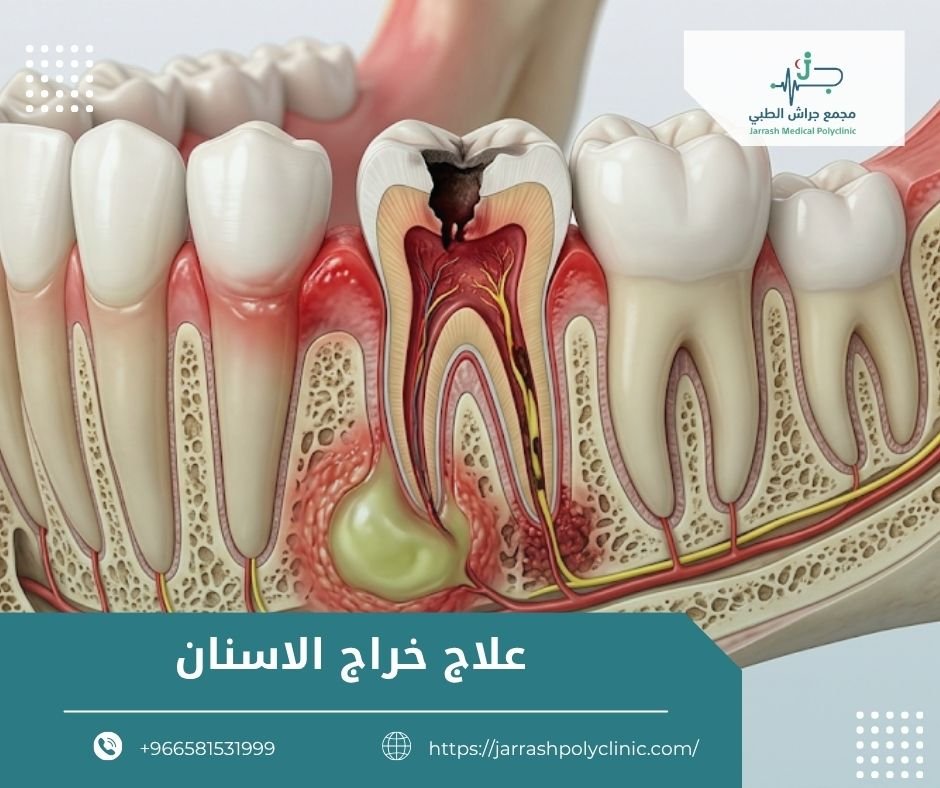 علاج خراج الاسنان