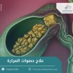 علاج حصوات المرارة