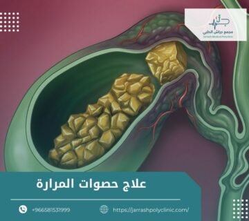 علاج حصوات المرارة