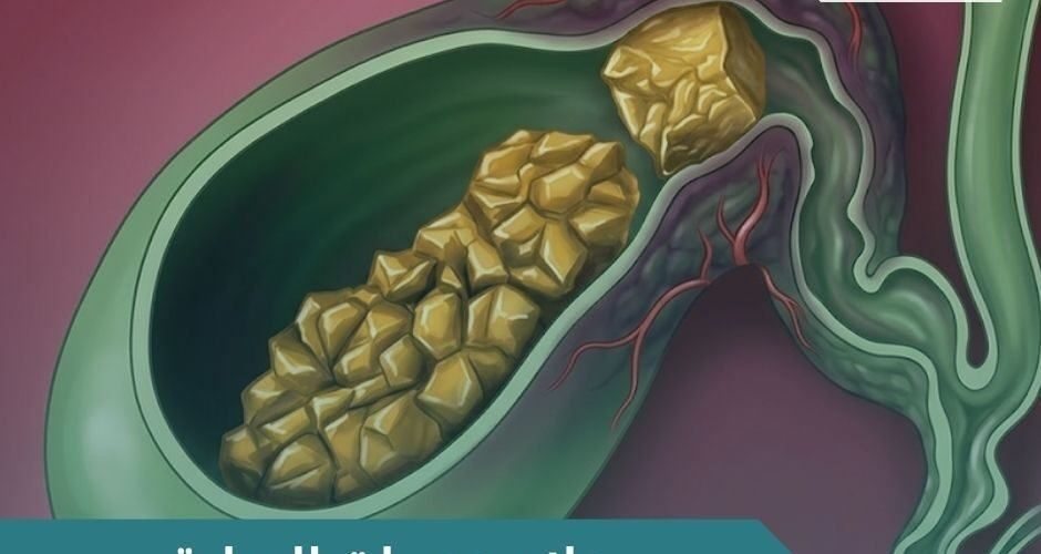 علاج حصوات المرارة