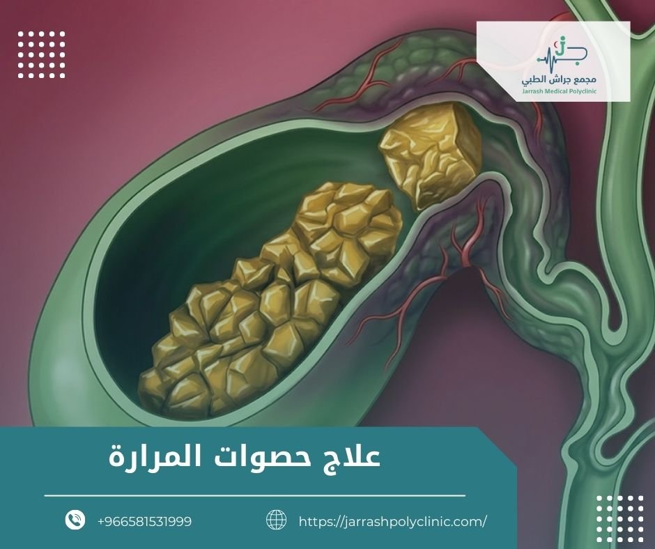 علاج حصوات المرارة