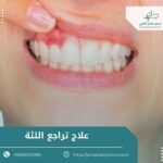 علاج تراجع اللثة
