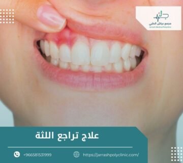 علاج تراجع اللثة