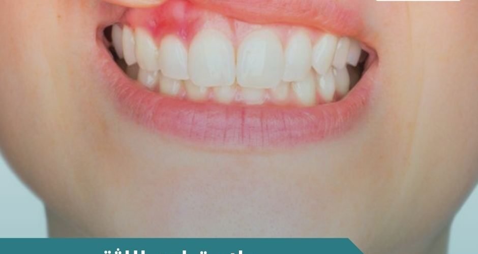 علاج تراجع اللثة