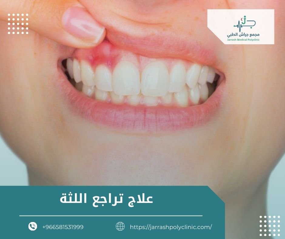 علاج تراجع اللثة