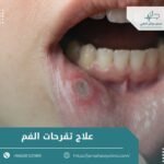 علاج تقرحات الفم