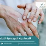 الحساسية الموسمية للجلد