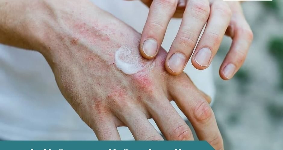 الحساسية الموسمية للجلد