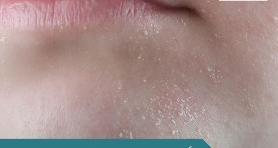 أسباب جفاف البشرة المفاجئ
