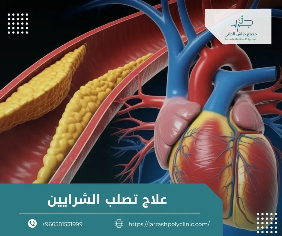 علاج تصلب الشرايين