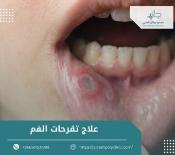 علاج تقرحات الفم