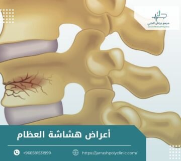 اعراض هشاشة العظام