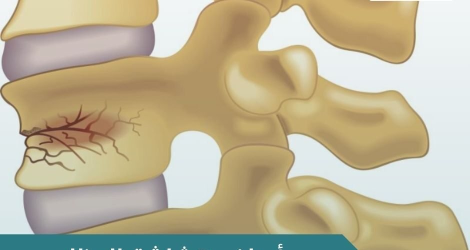 اعراض هشاشة العظام