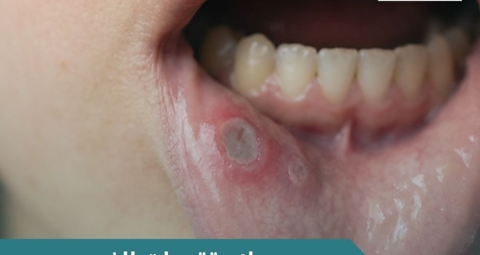 علاج تقرحات الفم