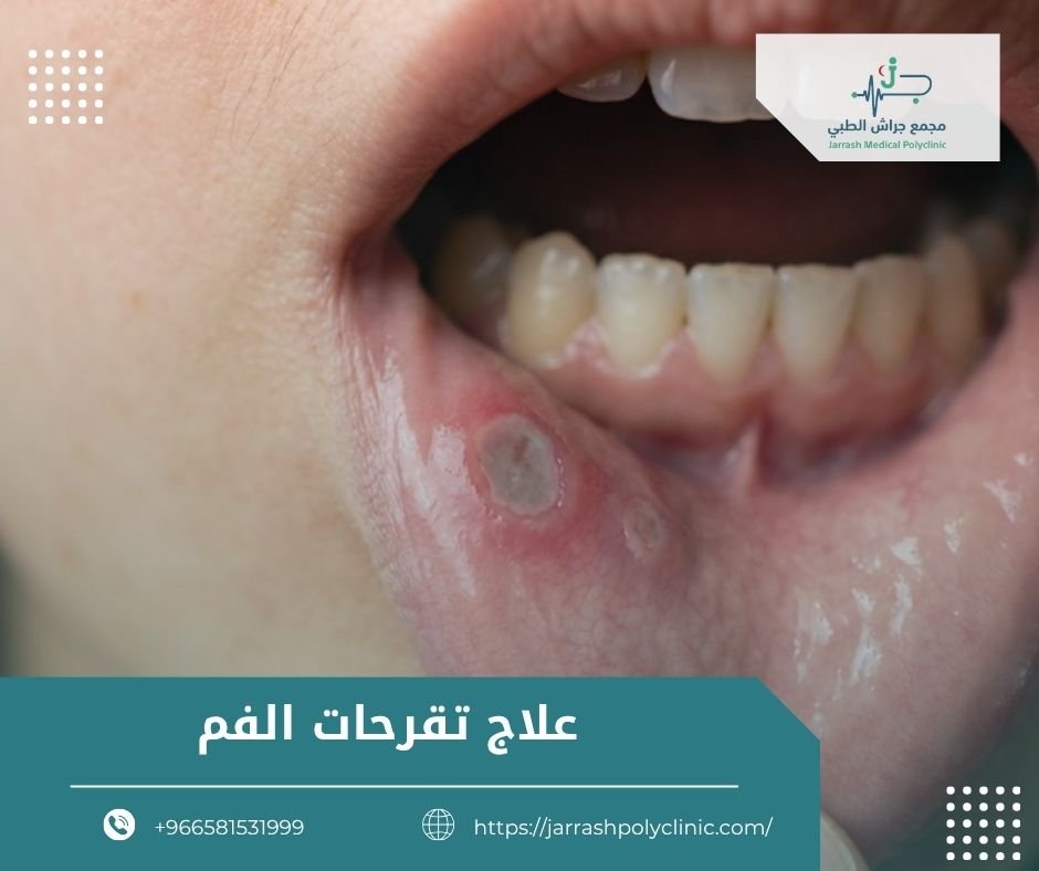 علاج تقرحات الفم