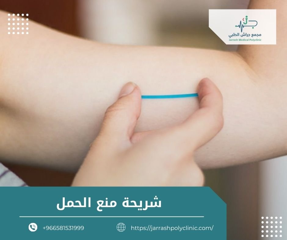 شريحة منع الحمل