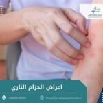 اعراض الحزام الناري