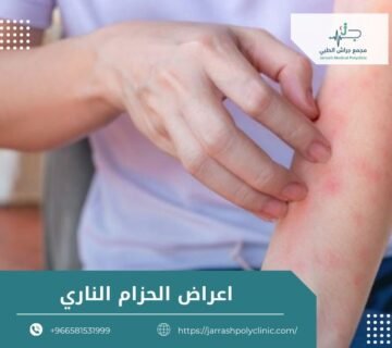 اعراض الحزام الناري