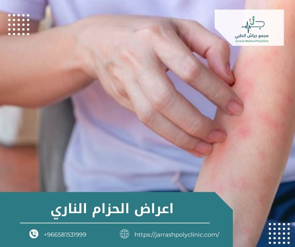 اعراض الحزام الناري