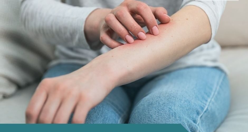 علاج الفطريات والحكة